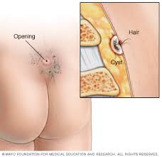 3 Ways to Get Rid of Acne on the Buttocks - wikiHow