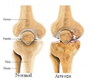 artroza la genunchi