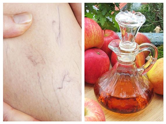 Tratamente naturiste cu oţet de mere şi miere! Cum ajută organismul