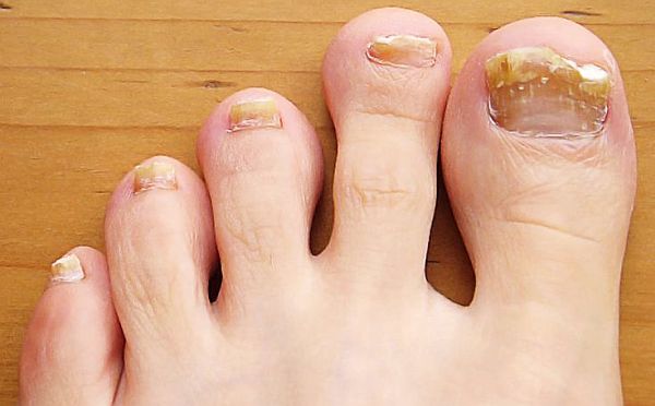 ingestia de medicamente pentru ciuperca unghiilor de la picioare