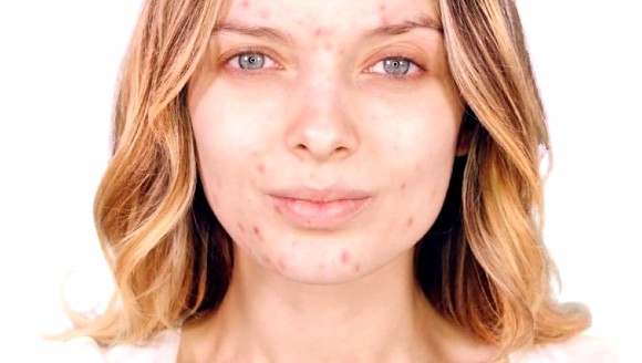 Adevaratele cauze ale acneei + solutia corecta
