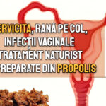Cervicita, rana pe col, infectii vaginale – tratament cu preparate din propolis 