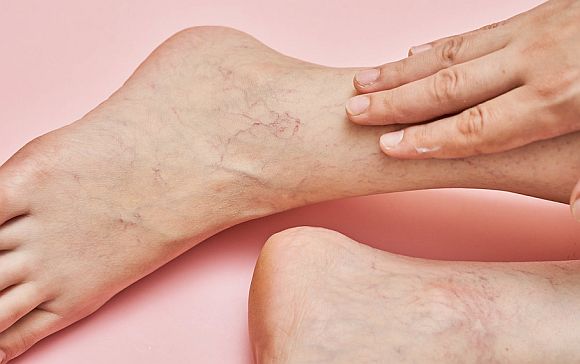 crema împotriva varicelor pe picioare mazi din mainile varicoase la femeile gravide