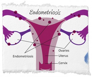 Endometrioza - Simptome și Tratament