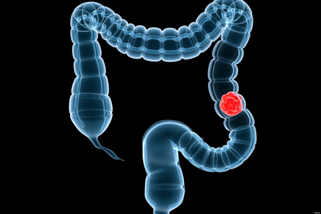 Ocluzia Intestinala Cauze Simptome Tratament LaTAIFAS