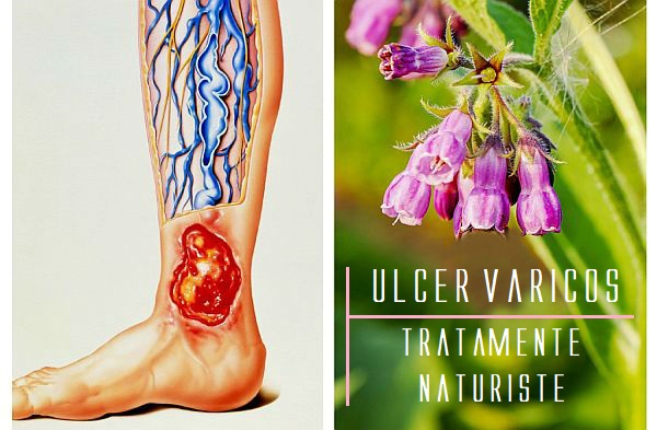 Ulcer Varicos 窶・Cauze ﾈ冓 Tratamente Naturiste