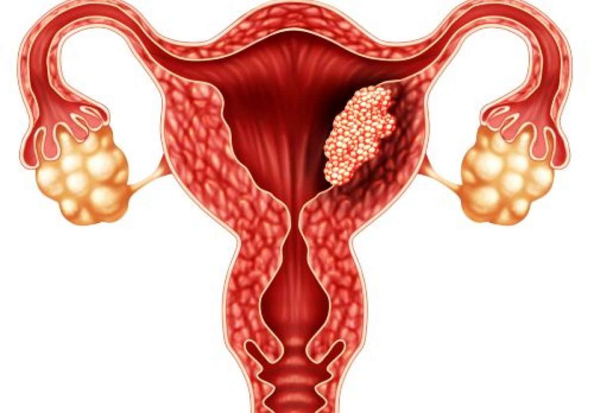 cancer endometru simptome)
