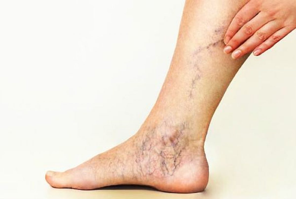 Tromboza picior tratament – Sanatate si frumusete