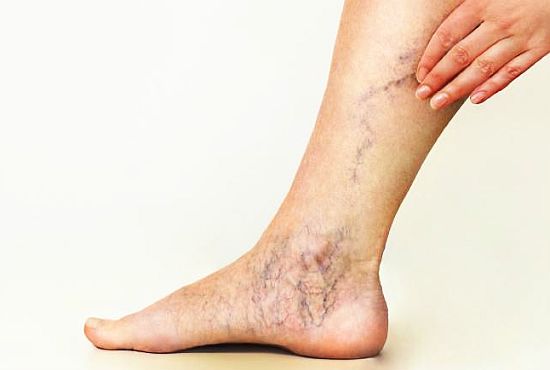 simptomele picioarelor varicoase varicoza condiii de munca daunatoare