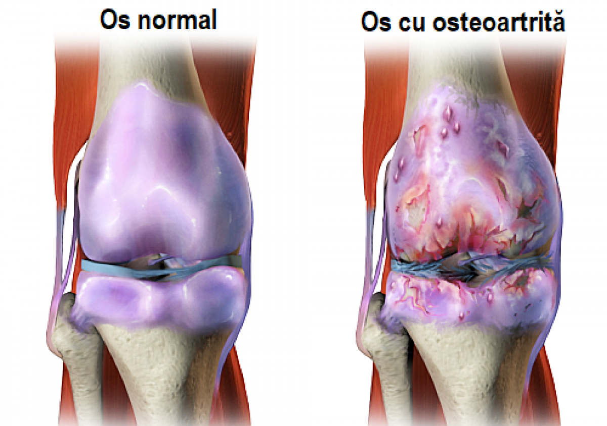 Osteoartrita genunchiului: tratament nechirugical prin exercitii la domiciliu