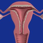 Care sunt stadiile cancerului ovarian – ce trebuie să știi