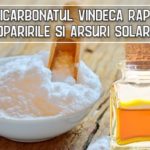 Bicarbonatul vindeca rapid oparirile si arsuri solare