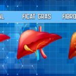Cum sa reduci grasimea din ficat in 14 zile