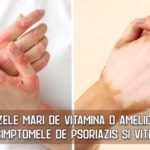 Dozele mari de vitamina D amelioreaza simptomele de psoriazis si vitiligo