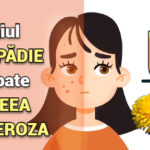 Ceaiul de papadie combate acneea si cuperoza – cum sa il folosesti